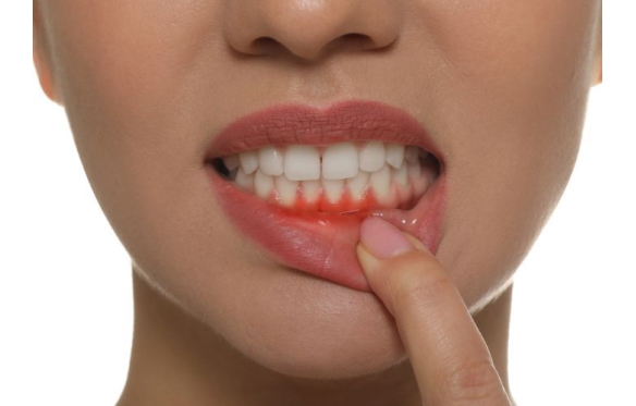 Viêm Nướu Do Răng Sứ: Nguyên Nhân, Biểu Hiện và Cách Khắc Phục Theo Chuyên Gia Từ Nha Khoa Smile