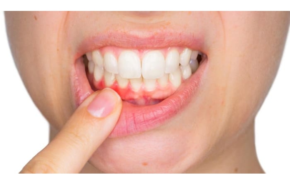 Cảnh Báo Dấu Hiệu Bất Thường Sau Khi Bọc Răng Sứ Và Những Triệu Chứng Bình Thường