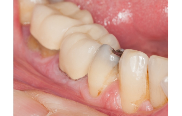 Răng Sứ Cho Răng Sâu An Giang | Khắc Phục Triệt Để, Ngăn Ngừa Tái Phát