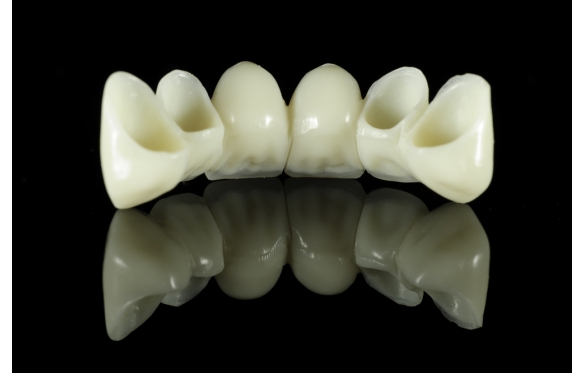 Quy trình làm cầu răng sứ - Hướng dẫn chi tiết từng bước từ chuyên gia Smile Dental