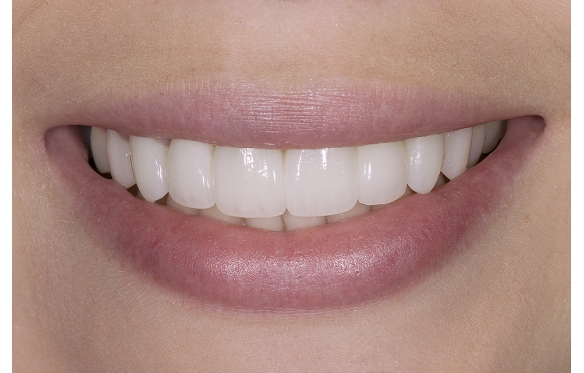 Răng Sứ 3M Lava Plus Tại Nha Khoa Smile Cần Thơ - Chất Lượng Cao, Giá Tốt