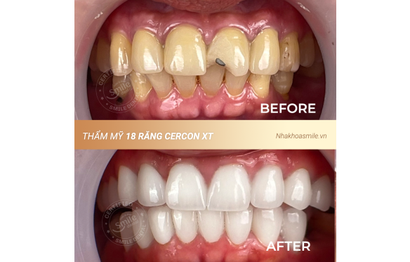 Tổng Quan Dịch Vụ Bọc Răng Sứ Cercon Chất Lượng Cao Tại Nha Khoa Smile 