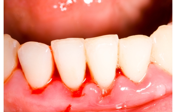 Các bệnh răng miệng phổ biến ở Cần Thơ do khí hậu | Nha khoa Smile 2025