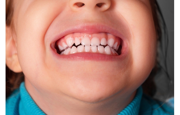 Bọc Răng Sứ Ở Độ Tuổi Nào Phù Hợp? Hướng Dẫn Chi Tiết Cho Từng Lứa Tuổi