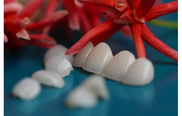 Nâng Cấp Nụ Cười Với Dịch Vụ Dán Sứ Veneer Tại Nha Khoa Smile Cà Mau