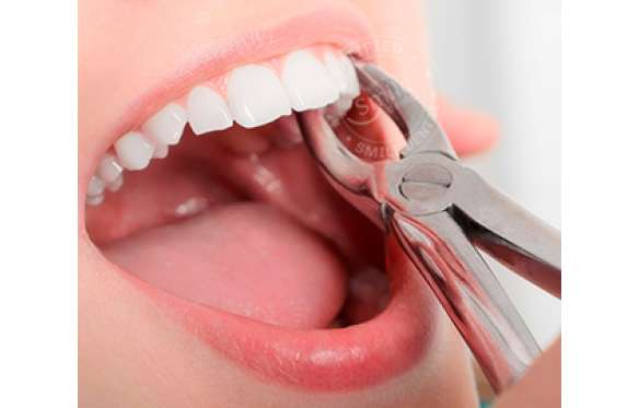 Dán sứ Veneer có cần nhổ răng khôn trước hay không?