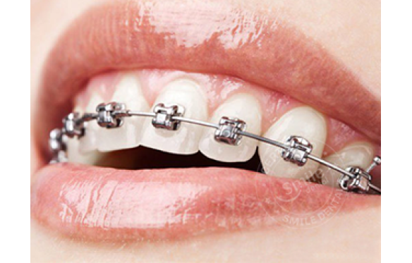 Có nên niềng răng mắc cài tự đóng?