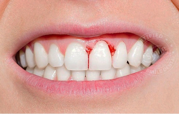 Điều Trị Cười Hở Lợi, Viêm Nướu Hiệu Quả tại Nha Khoa Smile