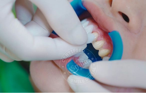 Dán Răng Sứ Không Mài Nhỏ: Hướng Dẫn Chi Tiết Về Giá Cả và Quy Trình