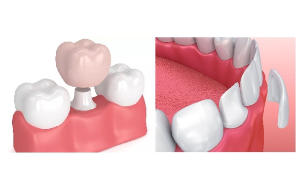 Nên Chọn Mặt Dán Sứ Veneer Hay Bọc Răng Sứ Tại Cần Thơ? So Sánh Chi Tiết Từ Nha Khoa Smile