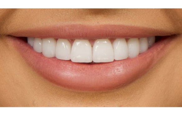 Tại sao răng nhạy cảm sau khi dán Veneer? Khắc phục thế nào? 