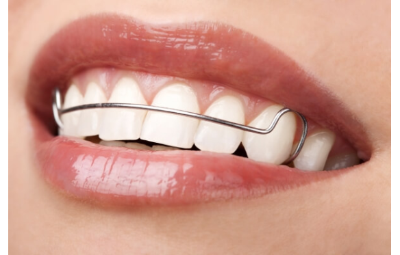 Dịch Vụ Niềng Răng Thẩm Mỹ Tại Nha Khoa Smile Rạch Giá