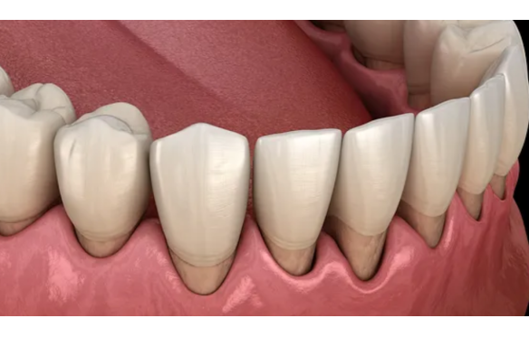 Hở Chân Răng Là Gì? Nguyên Nhân Và Cách Khắc Phục Hiệu Quả Tại Nha Khoa Smile