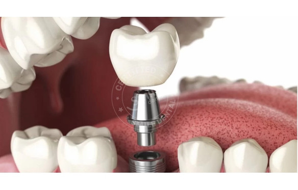 Dịch Vụ Cấy Ghép Răng Chất Lượng Tại Bạc Liêu - Giải Pháp Cấy Ghép Implant từ Nha Khoa Smile