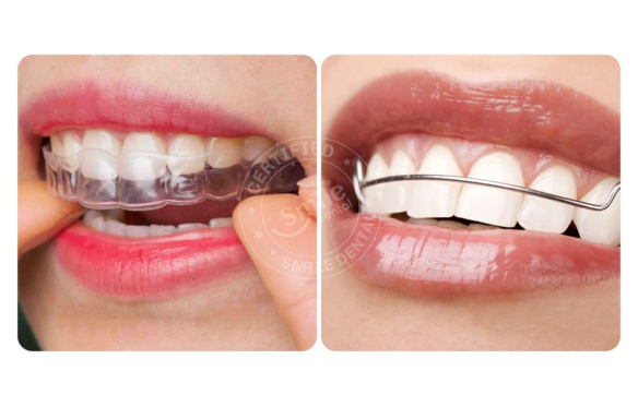 Tìm Hiểu Dịch Vụ Niềng Răng Tại Đồng Tháp - Nụ Cười Của Bạn Là Hạnh Phúc Của Smile