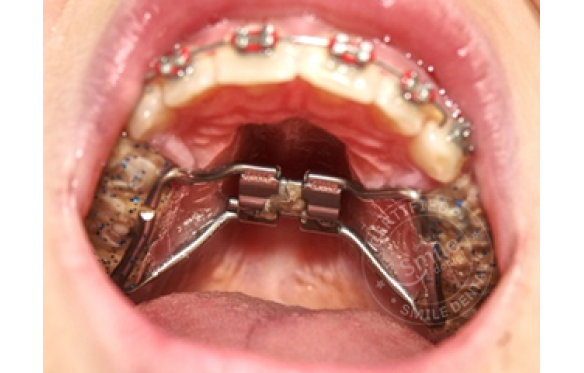 Khí Cụ Nâng Rộng Hàm: Cải Thiện Cấu Trúc Răng Hiệu Quả - Nha Khoa Smile Dental