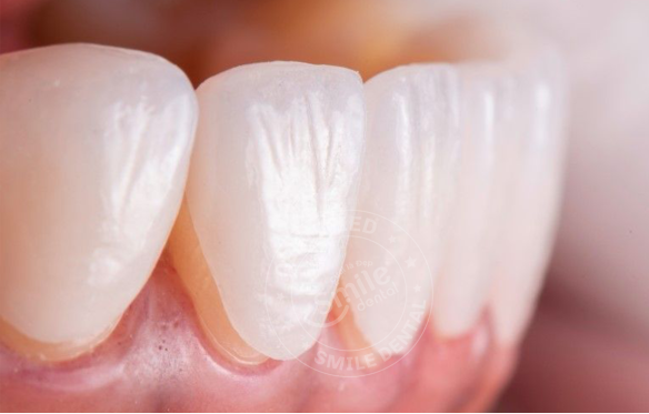Khi nào thì cần bọc răng sứ hàm dưới? Nên bọc bao nhiêu răng?