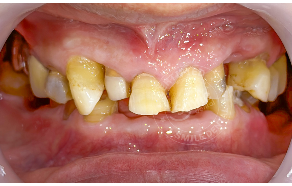 Răng Bị Khuyết Thiếu: Giải Pháp Phục Hình Thẩm Mỹ & Bền Chắc