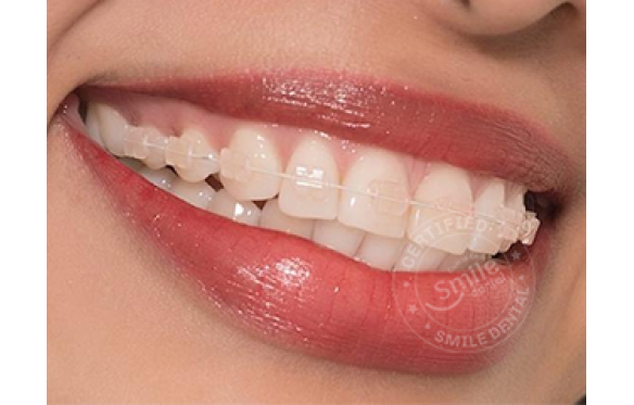 Mắc Cài Pha Lê - Lựa Chọn Thẩm Mỹ Hiện Đại Trong Chỉnh Nha Tại Nha Khoa Smile