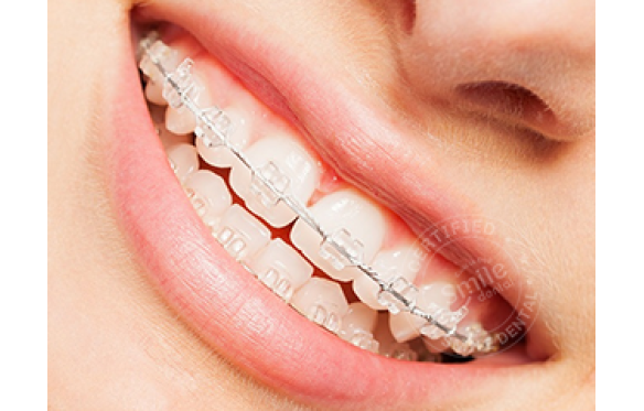 Mắc Cài Pha Lê Tự Động: Lựa Chọn Lý Tưởng Cho Nụ Cười Hoàn Hảo