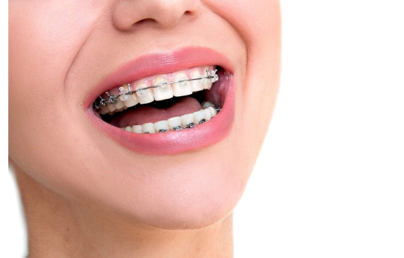 Niềng Răng Sứ Tại Nha Khoa Smile - Giải Pháp Thẩm Mỹ Và Hiệu Quả