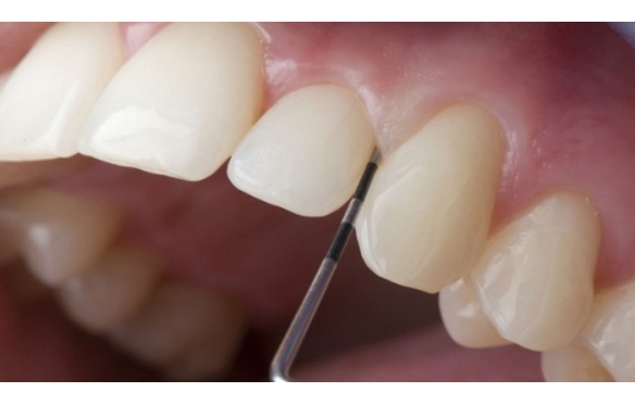 Mài Răng Để Bọc Răng Sứ - Những Gì Bạn Cần Biết Trước Khi Làm