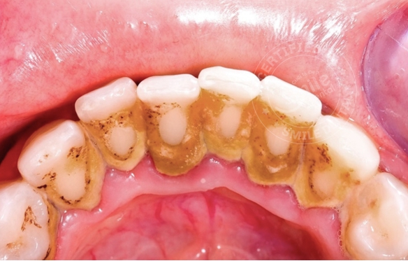 Mảng Bám Răng Miệng, Cao Răng: Cách Loại Bỏ & Phòng Ngừa