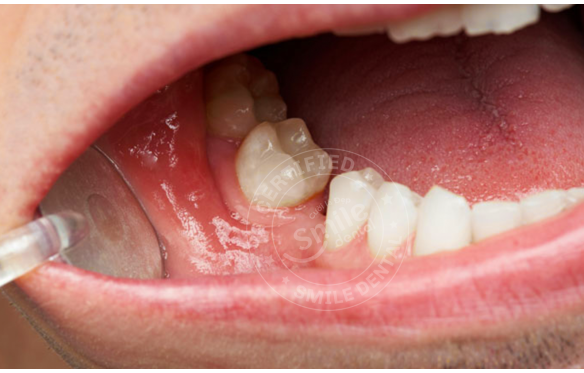 Mất Răng Do Bẩm Sinh: Giải Pháp Điều Trị & Phục Hình Răng