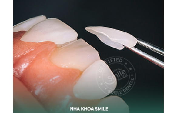 Mặt Dán Sứ Veneer Zirconia DDBio - Giải Pháp Hoàn Hảo Cho Nụ Cười Tự Tin