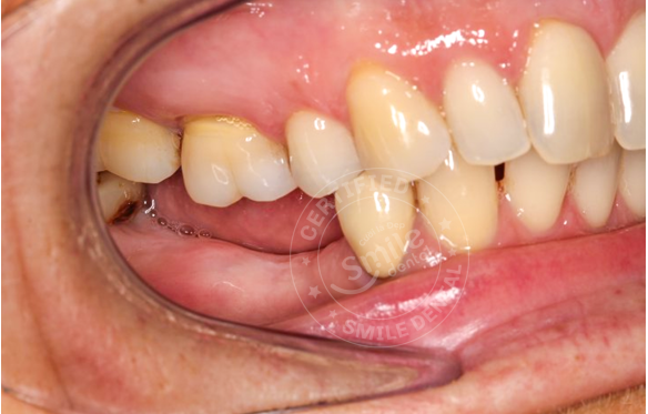 Mất Răng Hàm Nhai: Nguyên Nhân, Hậu Quả & Cấy Ghép Implant