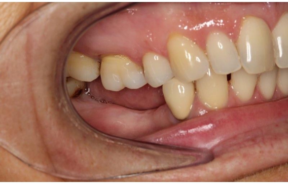 Cách Xử Lý Trường Hợp Tiêu Xương Và Còn Chân Răng | Nha Khoa Smile