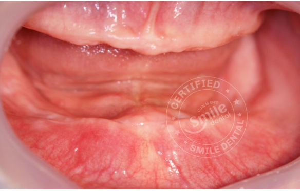 Mất Răng Nguyên Hàm: Giải Pháp Implant All-on-4, All-on-6