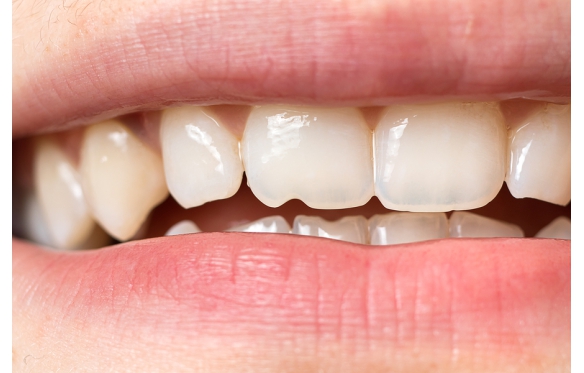 Răng Sứ Bị Mẻ, Vỡ: Cách Khắc Phục Hiệu Quả Tại Nha Khoa Smile