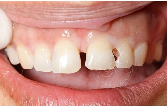 Mẻ Răng, Mất Răng: Khắc Phục Bằng Trám Răng, Bọc Sứ