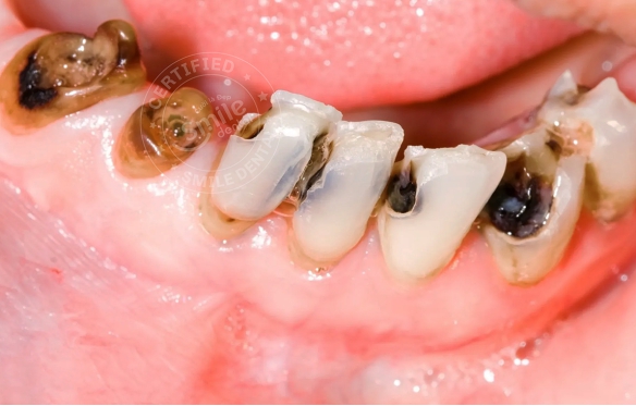 Mẻ Răng, Vỡ Răng, Sâu Răng: Nguyên Nhân & Cách Điều Trị