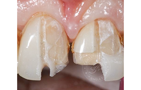 Mẻ vỡ Veneer có nguy hiểm không? Khắc phục thế nào? 