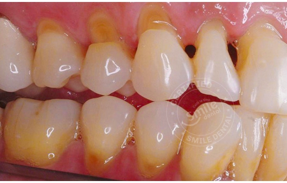 Mòn Cổ Chân Răng & Men Răng: Nguyên Nhân & Điều Trị