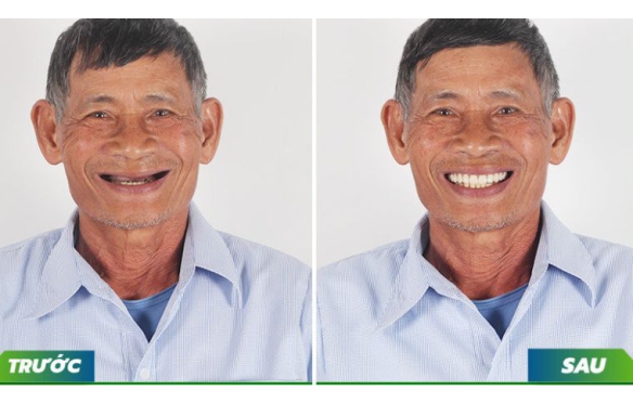 Răng Sứ Cho Người Già Tại Cà Mau: Bí Quyết Ăn Nhai Khỏe, Sống Vui