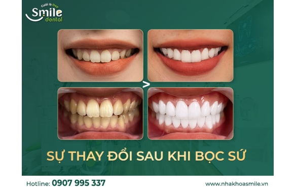 Bảng Giá Chi Phí Bọc Răng Sứ Thẩm Mỹ Tại Cần Thơ - Smile Dental