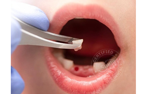 Nhổ Răng Sữa: Hướng Dẫn Chi Tiết, Quy Trình & Lợi Ích