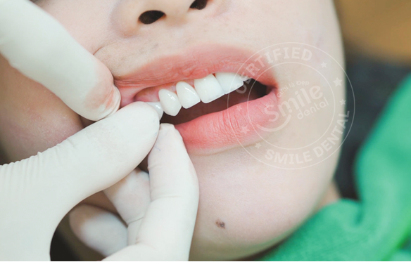 NHỮNG ĐIỂM NỔI BẬT CỦA PHƯƠNG PHÁP DÁN SỨ VENEER.