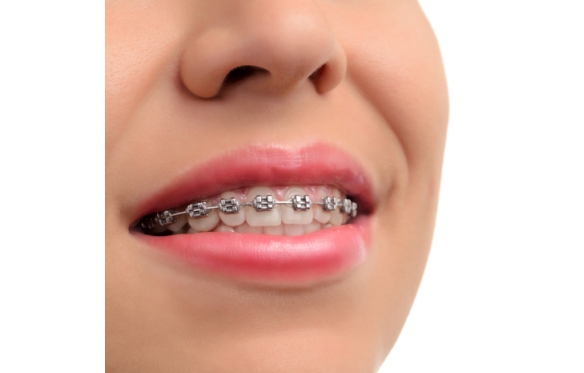 Dịch Vụ Niềng Răng Thẩm Mỹ Tại Nha Khoa Smile Ninh Kiều