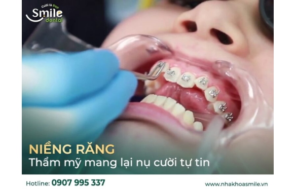 Dịch Vụ Niềng Răng Thẩm Mỹ Tại Nha Khoa Smile Hậu Giang