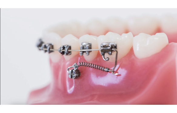 Minivis là gì? Có đau không? Giá bao nhiêu? [Giải thích dễ hiểu từ A–Z]