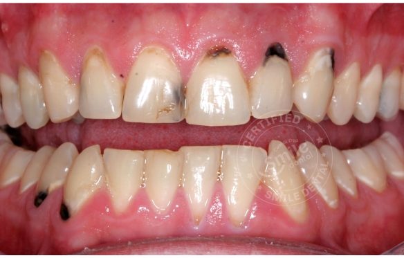 Răng Ố Vàng, Nhiễm Tetracycline: Tẩy Trắng & Bọc Sứ