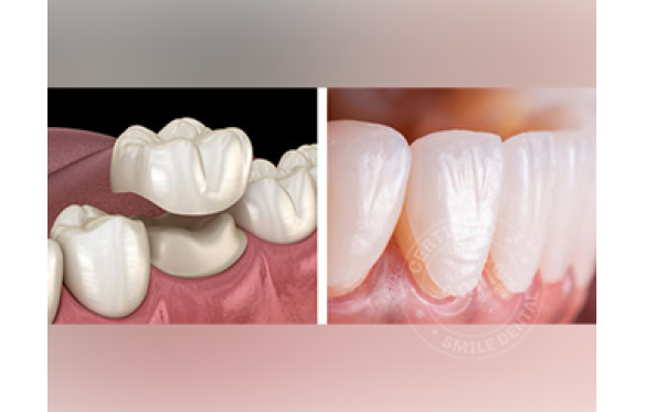 Phân biệt bọc sứ thẩm mỹ và dán sứ Veneer thẩm mỹ