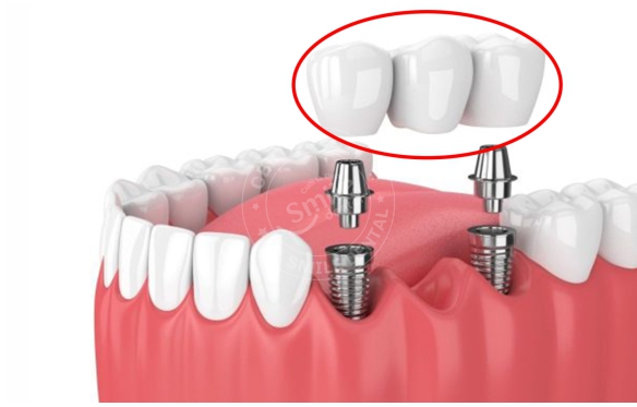 Phục Hình Răng Trên Implant: Giải Pháp Thẩm Mỹ & Chức Năng