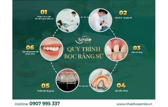 Quy Trình Làm Răng Sứ Cao Cấp Orodent White Matt tại Nha Khoa Smile Bạc Liêu