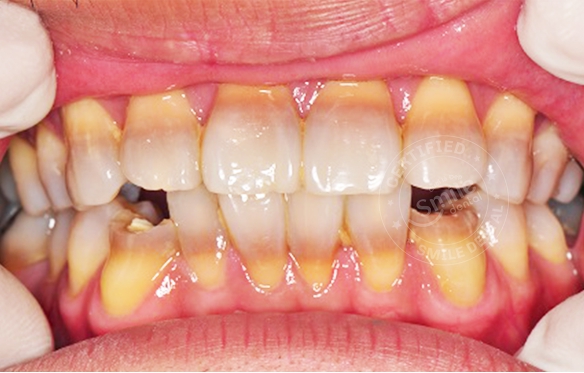 Răng Nhiễm Tetra, Ố Vàng: Giải Pháp Tẩy Trắng & Phục Hình