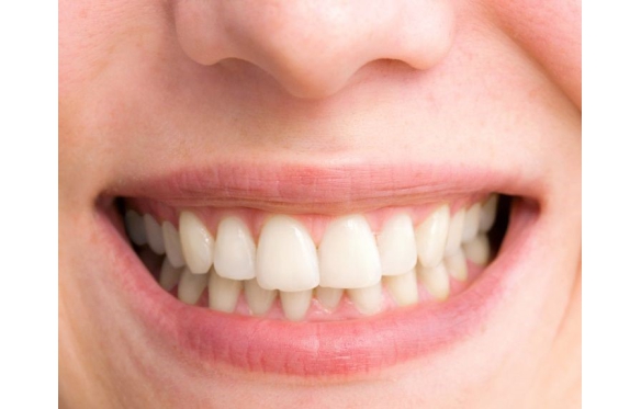 Bọc Răng Sứ Cho Răng Hô Nhẹ Tại Miền Tây Cần Thơ: Giải Pháp Nhanh Chóng & Hiệu Quả